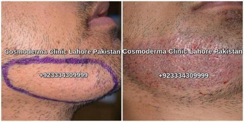 Beard Hair Transplant Surgery Clinic Lahore Pakistan Best Hair Surgeon